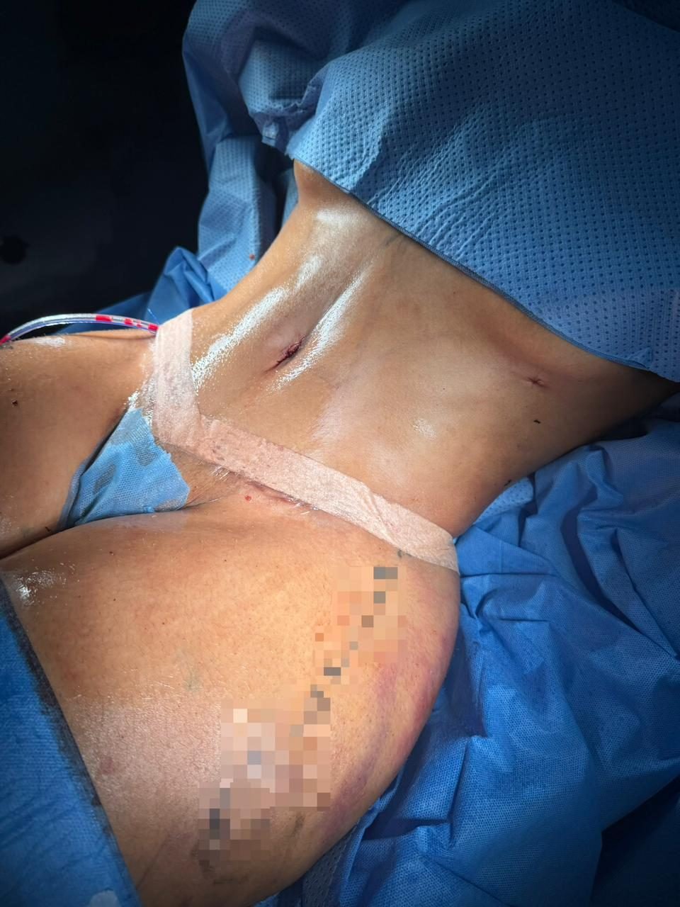 Abdominoplastia