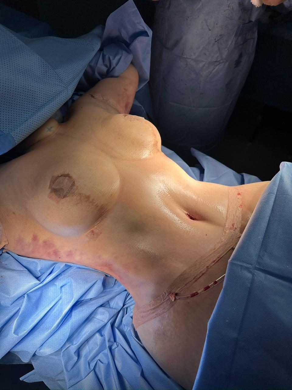 Tummy Tuck Liposuction BBL